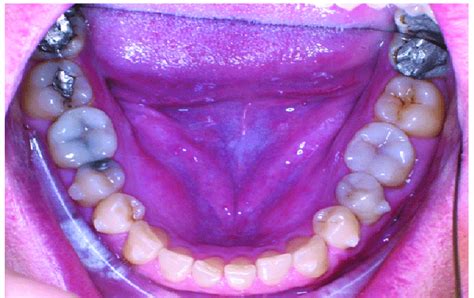 Lower Teeth Stripping And Initiation Of Invisalign Of The Lower Dental Arch Download