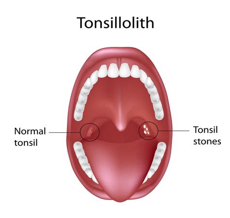 Tonsils stones also called tonsilliths, are small clumps of whitish, odorous collections of bacteria or debris on or in the surface crevices (crypts) of the tonsils. Tonsil Stones Stink - Kids Discover