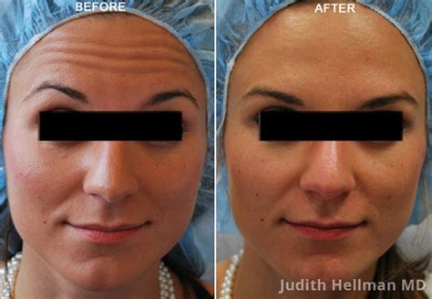Botox And Dysport Before And After Photos Ny