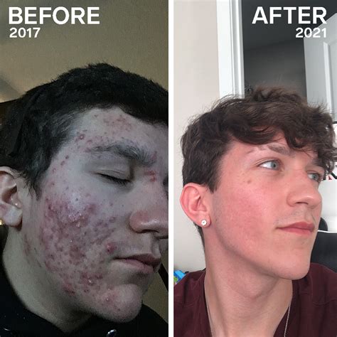 Acne 6 Month Accutane Course And Time For Pih To Fade Has Left Me