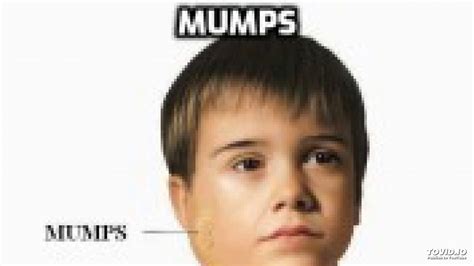 Mumps Parotitis Youtube
