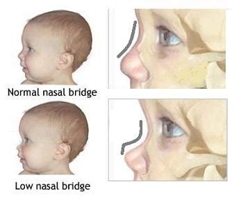 This disorder delays the development of multiple body parts. Williams Syndrome - Causes, Picture, Symptoms And Treatment