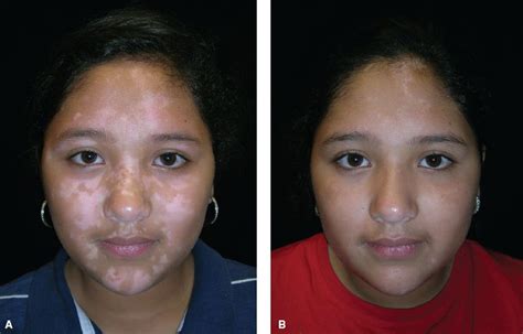 Vitiligo In Children Best Vitiligo Treatment