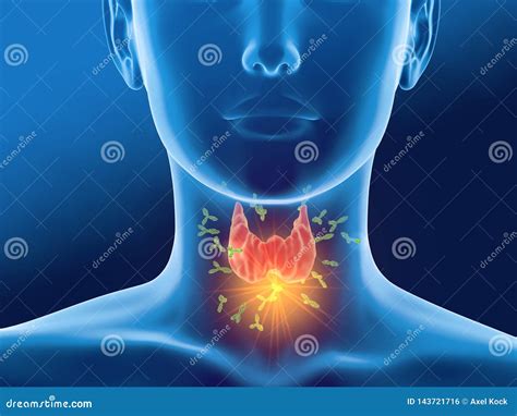 Antibodies Attacking Thyroid Gland Of A Woman Autoimmune Thyroiditis