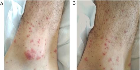 Scielo Brasil A 19 Year Old Man With Iga Vasculitis After