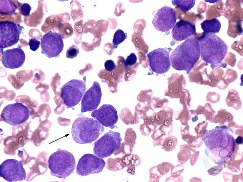 Acute Promyelocytic Leukemia 2