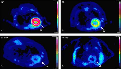 Take the usual insulin doses the day if your are on oral medications sulphonylurea, insulin secretagogues, or insulin, your pet scan. Inhibition of Physiologic Myocardial FDG Uptake in Normal ...