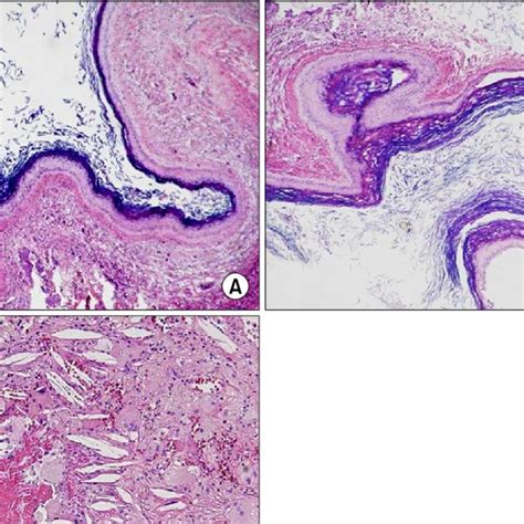 Pdf Giant Sized Epidermal Inclusion Cyst Of The Breast Initially