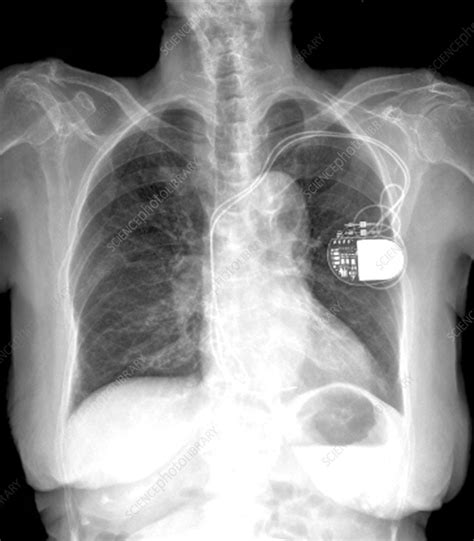 Heart Pacemaker X Ray Stock Image C0096781 Science Photo Library