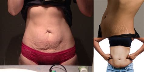 Diary Of A Fit Mommystretch Marks Saggy Skin Excess Fat Oh My