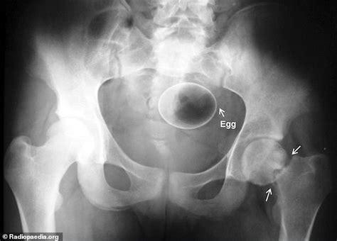 Bizarre Objects Stuck Inside People S Orifices That Required Emergency Room Visits Are Revealed