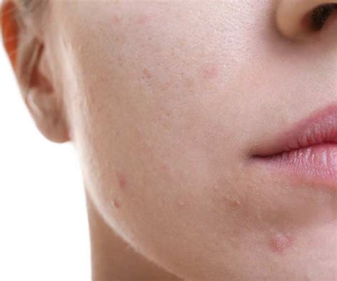 This Is The Worst Thing To Put On A Zit According To A Dermatologist