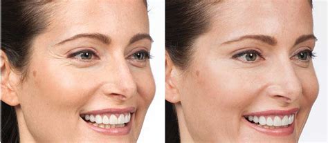 Botox Before And After Gallery Contour Dermatology