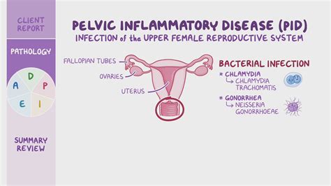 Pelvic Inflammatory Disease Pid Nursing Process Adpie Osmosis
