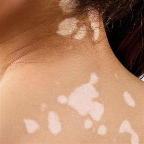 Causes Of Skin Discoloration Hypophil