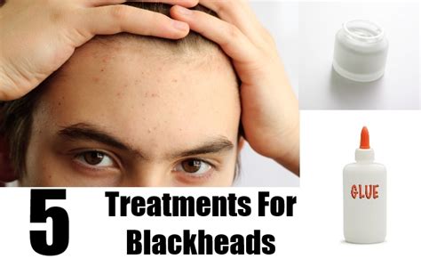 5 Treatments For Blackheads Natural Home Remedies And Supplements