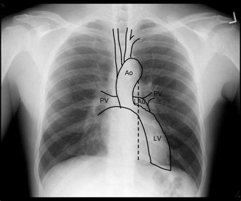 The Chest X Ray In Cardiovascular Disease Wikidoc