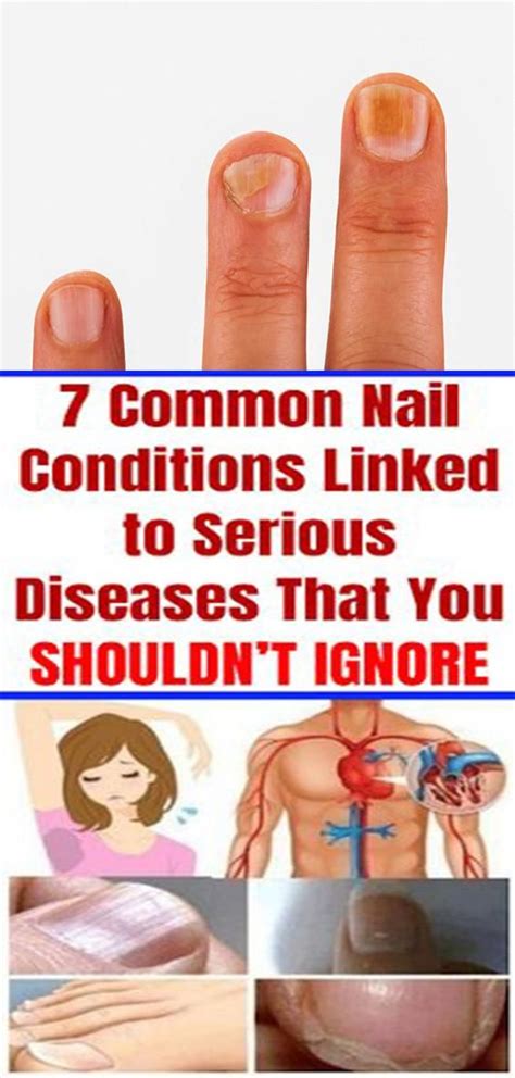 you shouldnt ignore these 5 warning symptoms your nails might be pointing to a disease in 2020