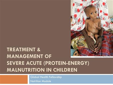 Ppt Treatment And Management Of Severe Acute Protein Energy
