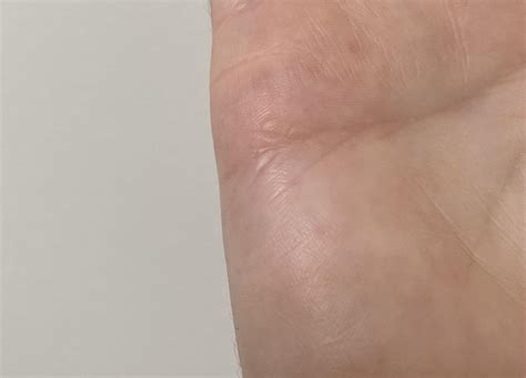 White Bumps On Hands Images And Photos Finder