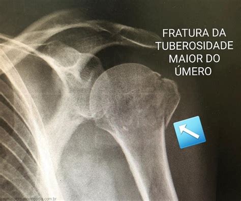 Tubérculo Maior Do úmero