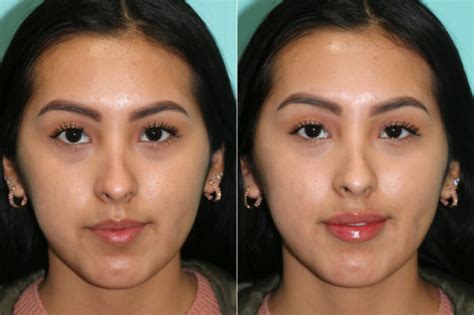 Lip Augmentation Before And After Photos Page 5 Of 6 Plastic