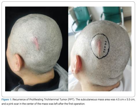 Proliferating Trichilemmal Tumor Of The Scalp A Case Report And