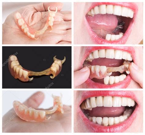 Rehabilitación Dental Con Prótesis Superior E Inferior Antes Y Después