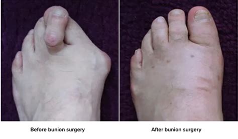 Prostep Mis For Bunion Correction Surgery Stryker