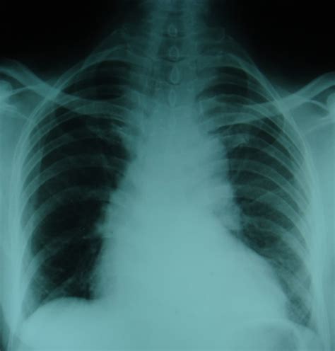 Unfolding Of Aorta On Chest X Ray