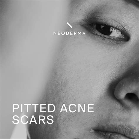 Pitted Acne Scars Neoderma