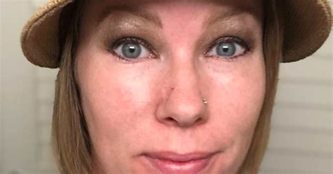 Irritated Acne Scar Turned To Horrific Skin Cancer On Womans Nose