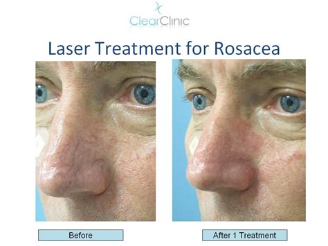 Rosacea Treatment With Laser And Antibiotics Clear Clinic Acne And Acne