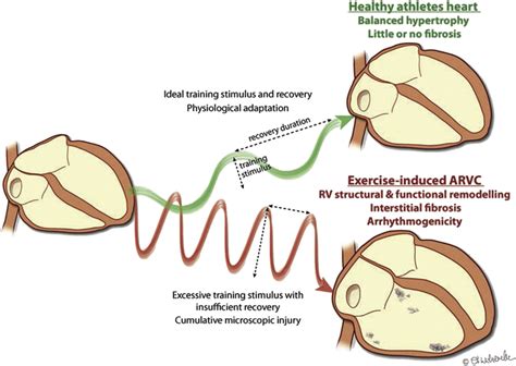relationship between arrhythmogenic right ventricular dysplasia and exercise cardiac