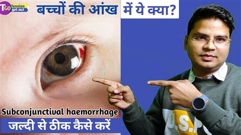 Best Eyedrop For Red Eyes Subconjunctival Hemorrhage Eye Care Tips