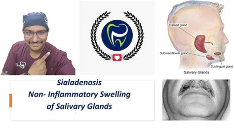 Dr Rudra Mohanpainless Swelling And Enlargement Of Salivary Glands
