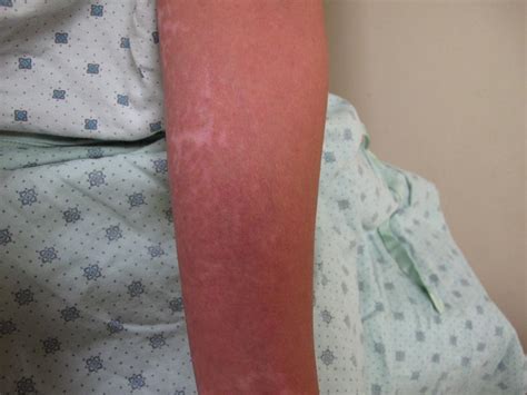 Eczema Of Arm On Brown Skin With Hypopigmentation Eczema In Skin Of Color