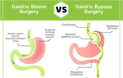 Gastric Bypass Vs Gastric Sleeve Which One Is Right For You Fitness And Health Advisor