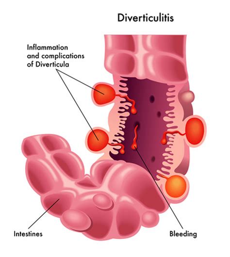 Diverticulitis And Low Back Pain Common Complications Treatments