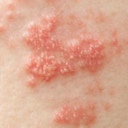 These rashes can present quite early on in the infection, but can also last a long time after, when the patient is no longer contagious. Skin rash: 68 pictures, causes, and treatments