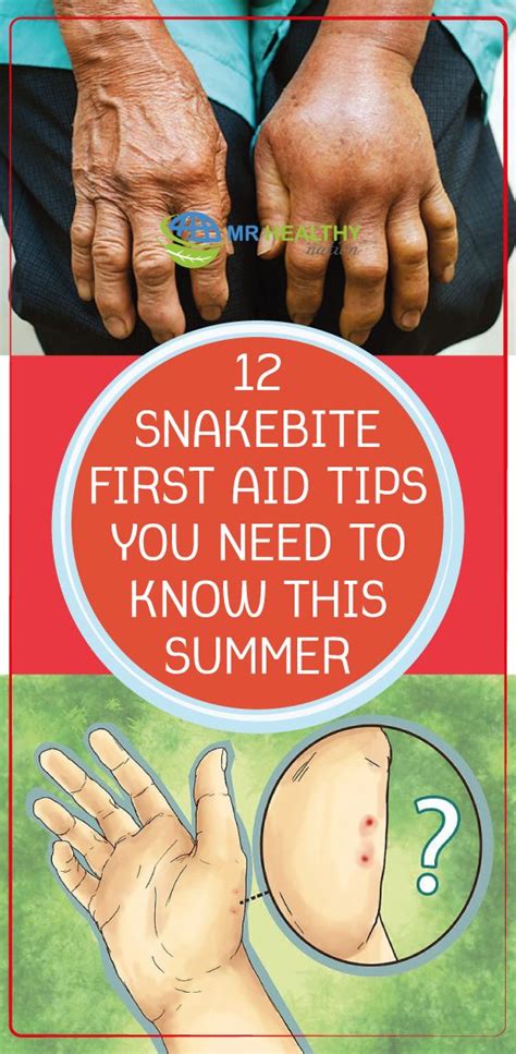 Snakebite First Aid Tips You Need To Know This Summer First Aid Tips Snake Bites Tips