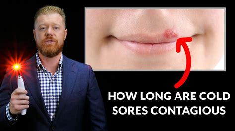 How Long Are Cold Sores Contagious Youtube