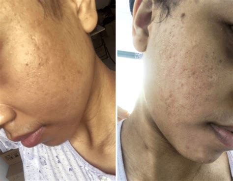 How I Lessened My Pimples Acne Scars And Pigmented Marks In 1 Month By