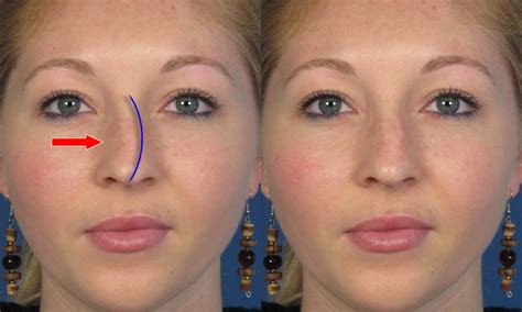Crooked Nose Before And After Rhinoplasty Nose Surgery Photos 2018