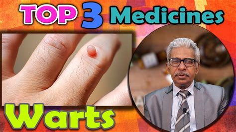 Top 3 Homeopathy Medicines For Warts Dr Ps Tiwari Youtube