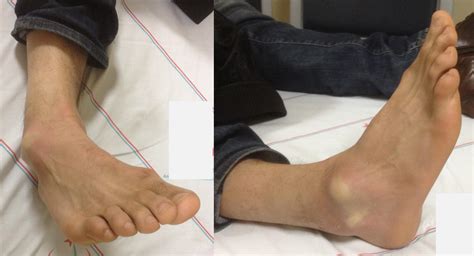 Dislocated Broken Ankle Pictures Janainataba