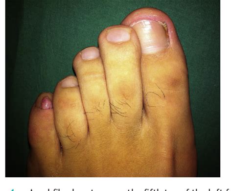 Figure 1 From Fox Fordyce Disease With An Atypical Clinical
