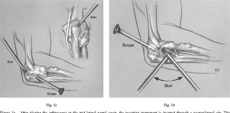 Figure 1 From Arthroscopic Synovectomy Of The Elbow For Rheumatoid