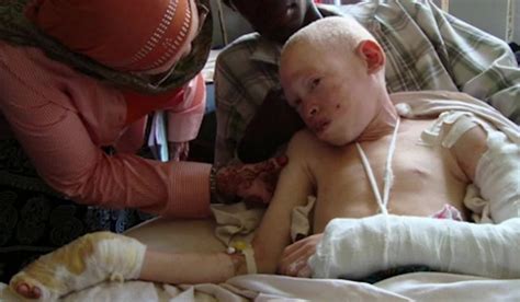 Atacan A Una Adolescente Albina Para Quitarle Partes ‘mágicas De Su Cuerpo Cnn