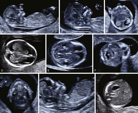 Ultrasound Screening For Fetal Abnormalities In The First Trimester